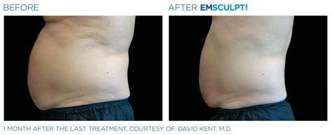 emsculpt temecula, ca|Dr. Sculpt CoolSculpting & EmSculpt Center .